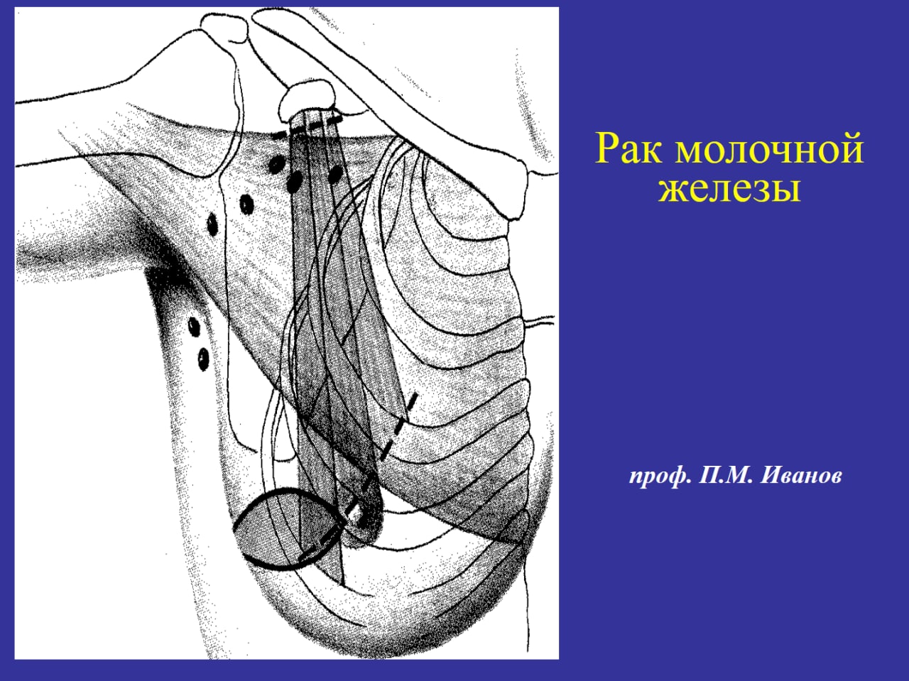 Рак молочной железы п п