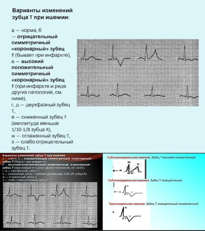 Неспецифические изменения st t нижней стенки лж